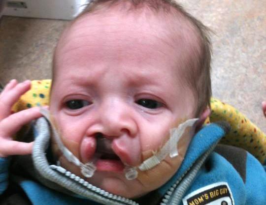 baby with Cleft palate