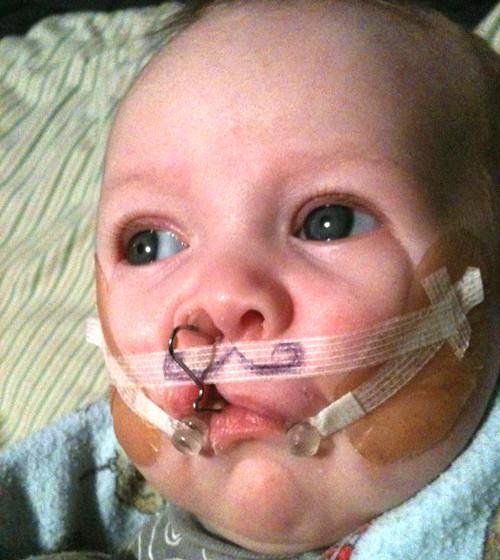Baby with cleft palate repair in progress